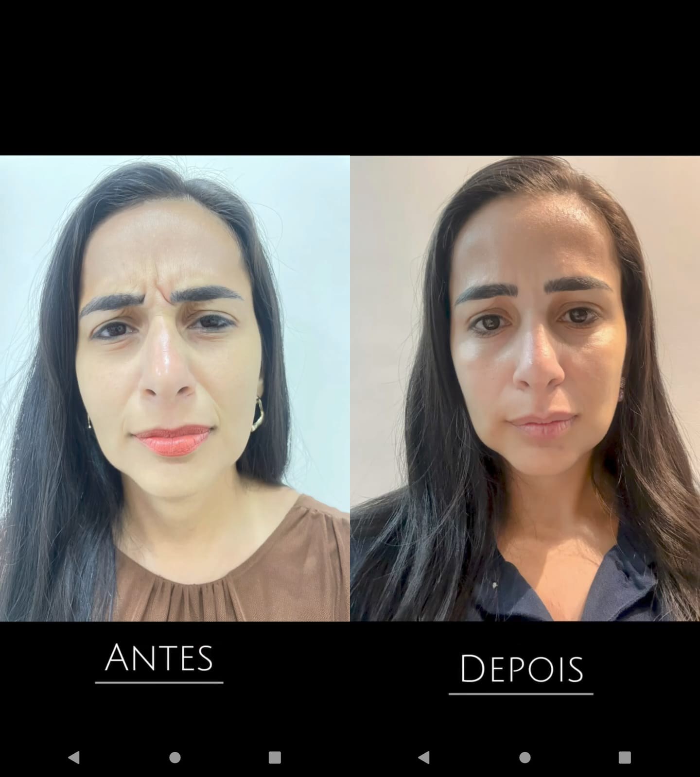 Toxina botulínica — antes e depois, Dra. Taiane Rodrigues