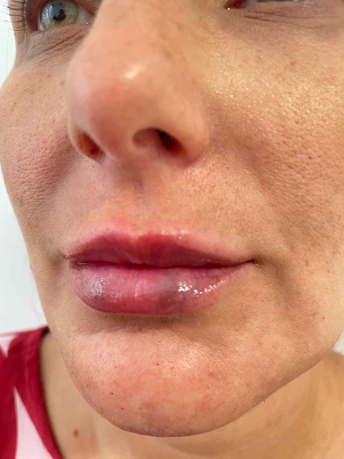 Preenchimento labial — antes e depois, Dra. Taiane Rodrigues