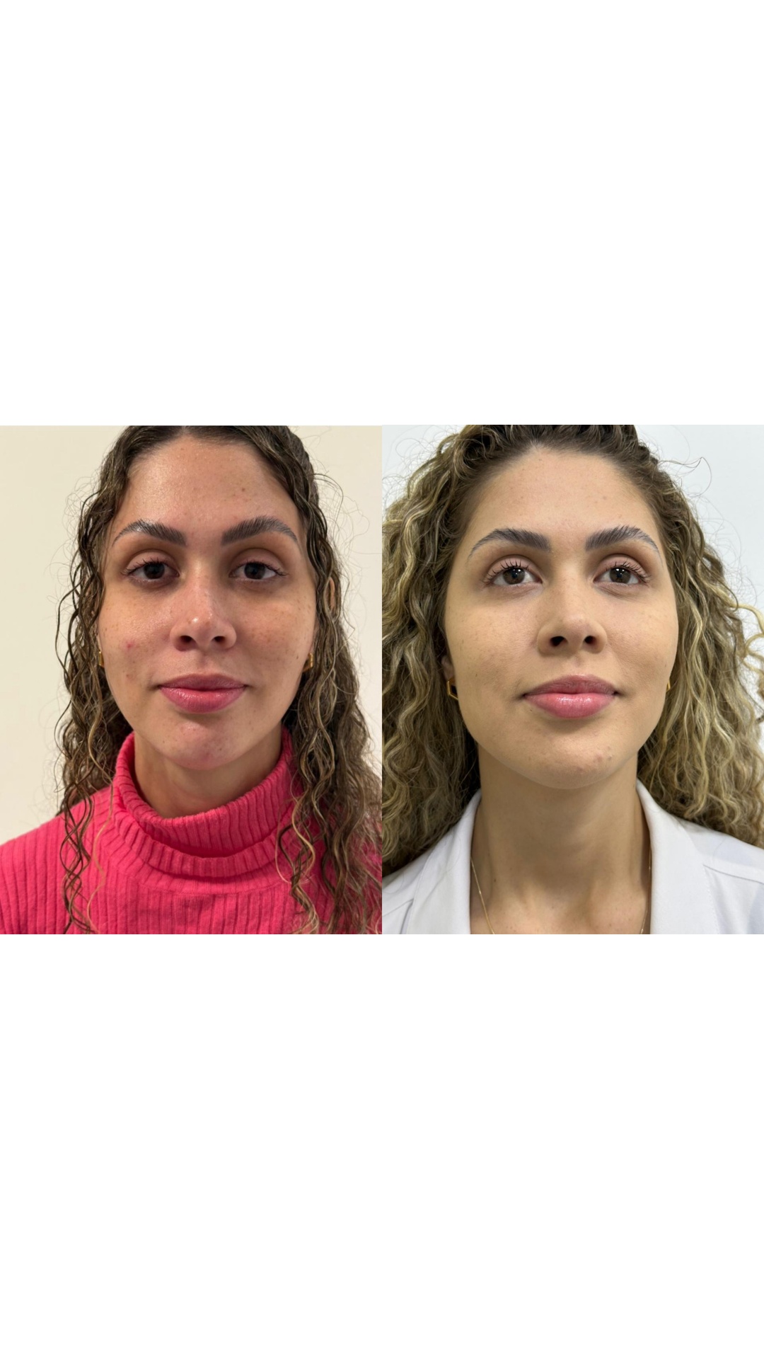 Harmonização facial — antes e depois, Dra. Taiane Rodrigues