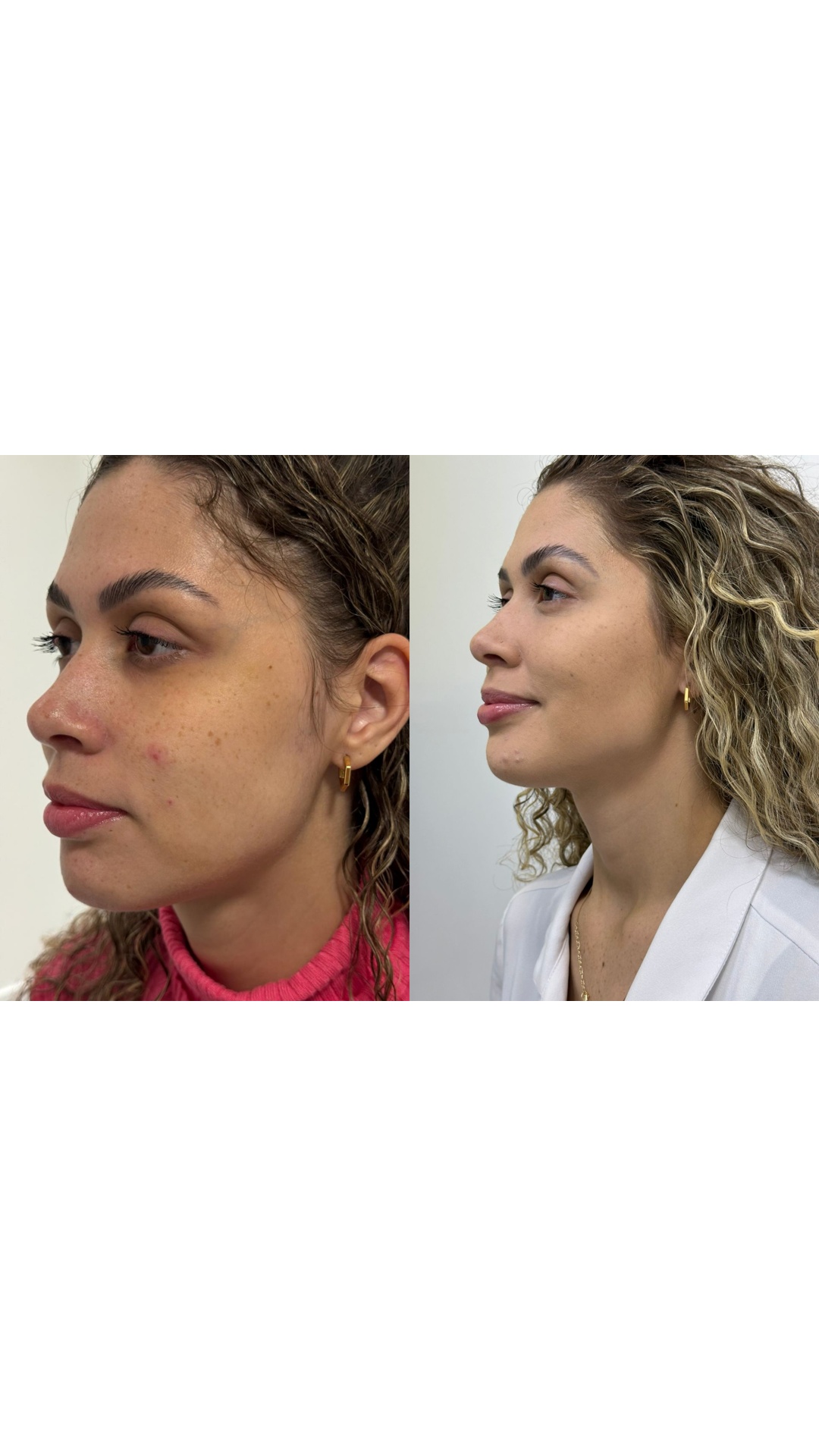 Harmonização facial — perfil — antes e depois, Dra. Taiane Rodrigues