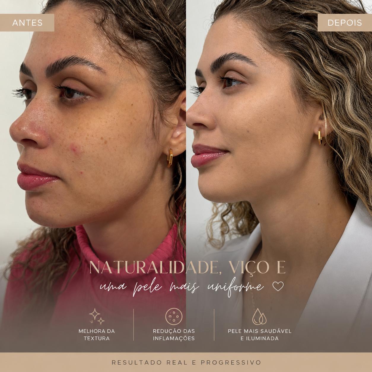 Antes e depois de harmonização facial — naturalidade e viço