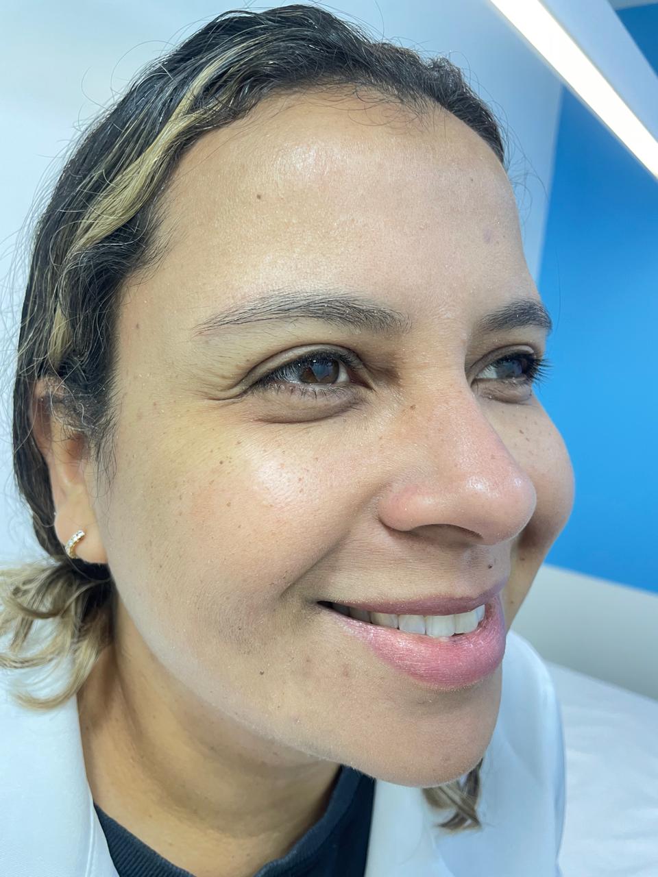 Rejuvenescimento facial — antes e depois, Dra. Taiane Rodrigues