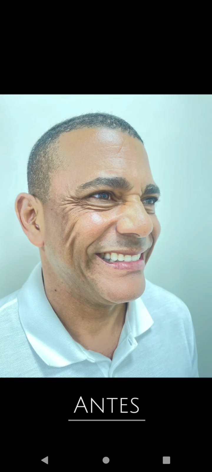 Pés de Galinha — Antes