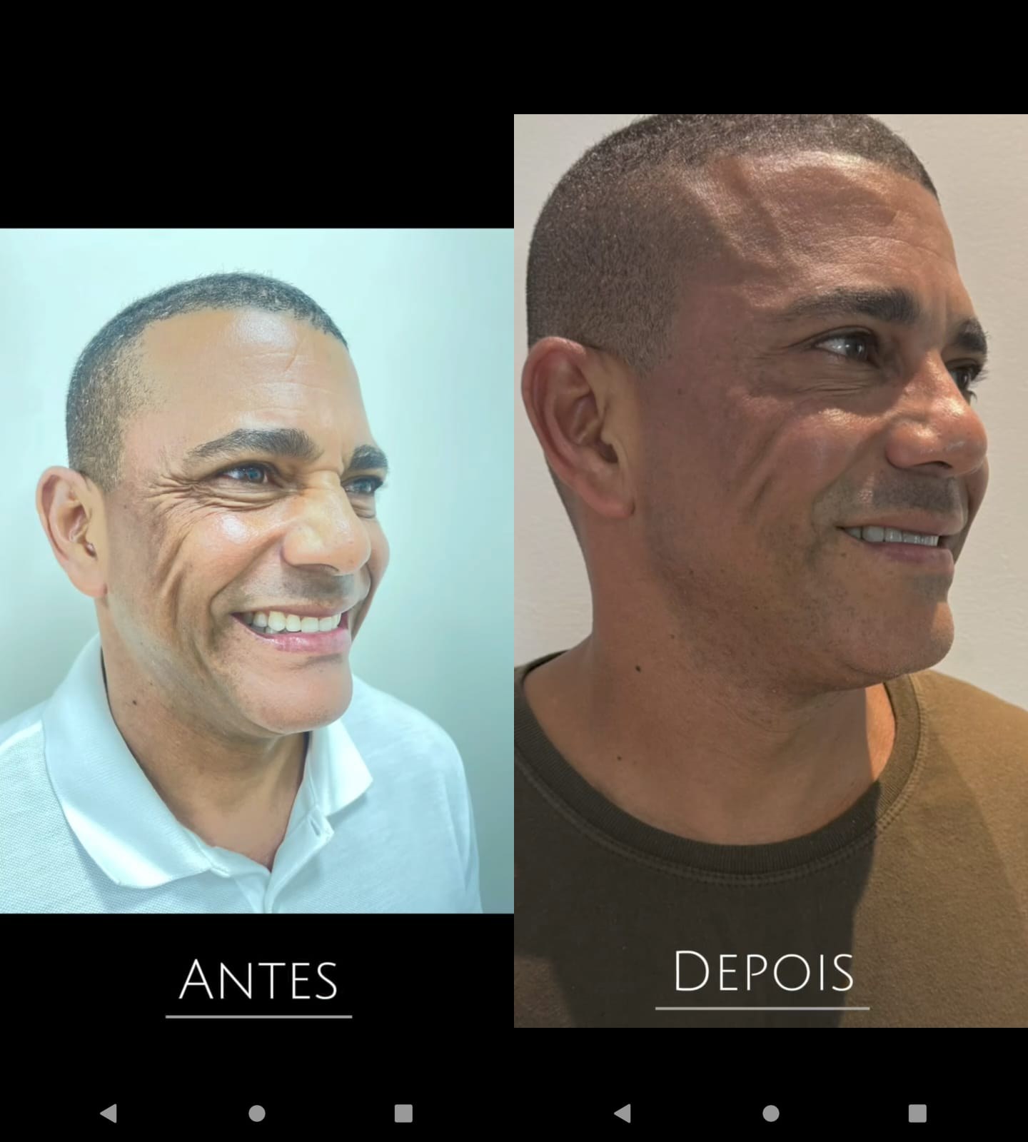 Harmonização facial masculina — antes e depois, Dra. Taiane Rodrigues