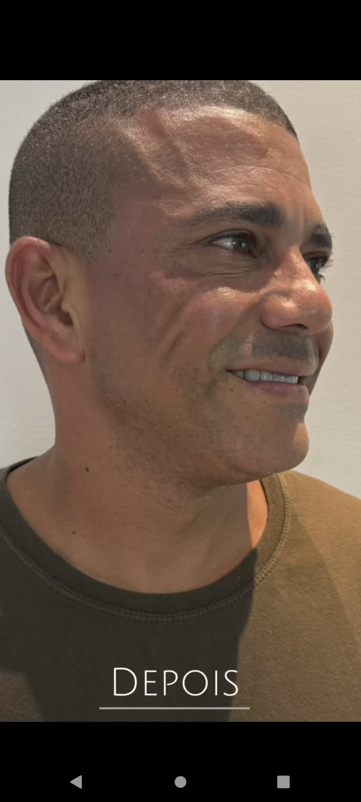 Pés de Galinha — Depois