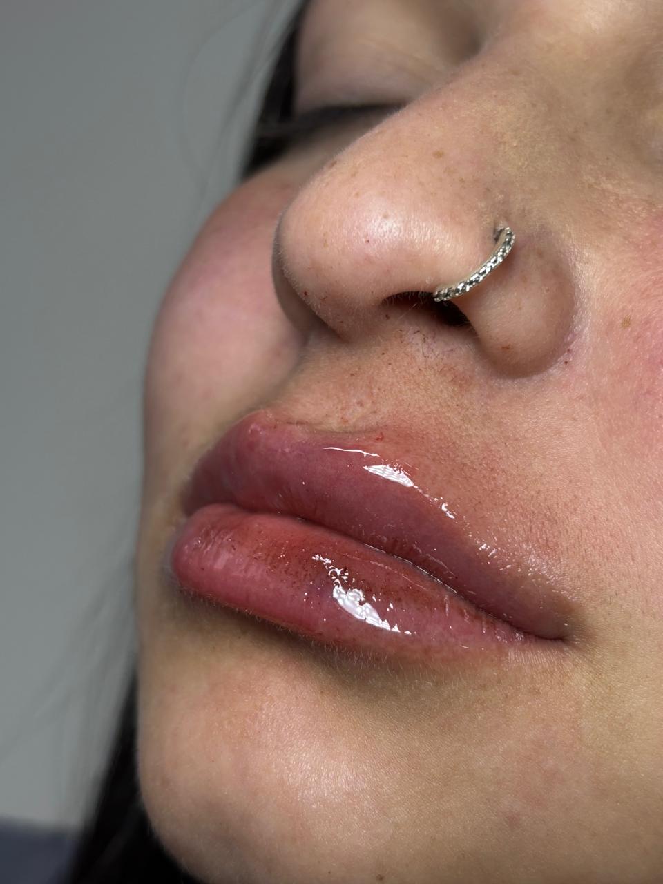 Preenchimento labial — antes e depois, Dra. Taiane Rodrigues