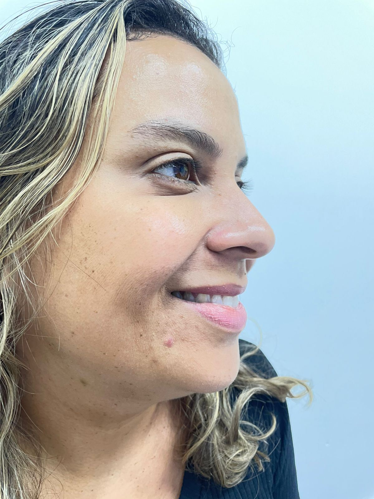 Contorno facial — antes e depois, Dra. Taiane Rodrigues